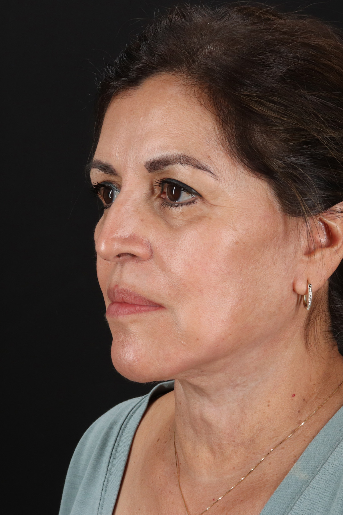 Lower Blepharoplasty Before & After Patient #13063