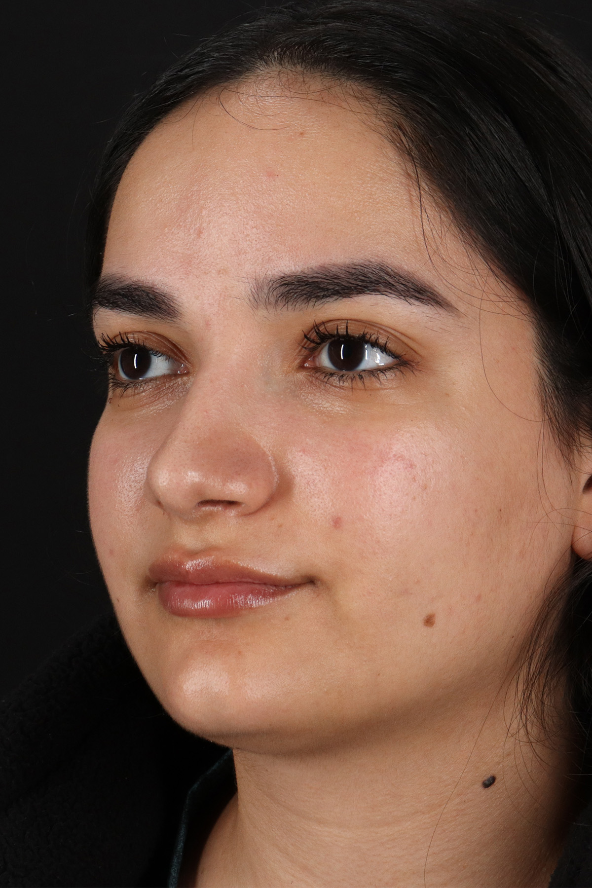 Rhinoplasty Before & After Patient #12436