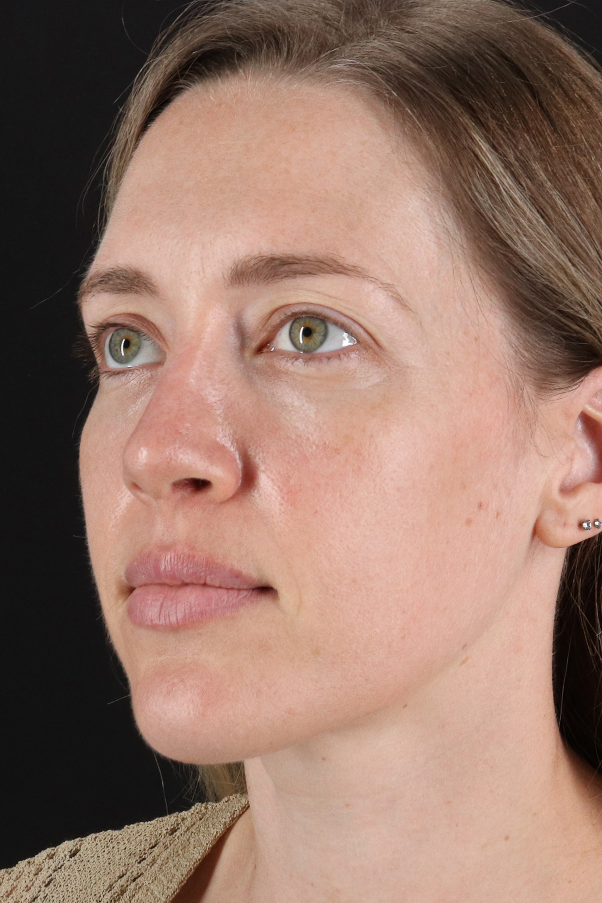 Rhinoplasty Before & After Patient #12227