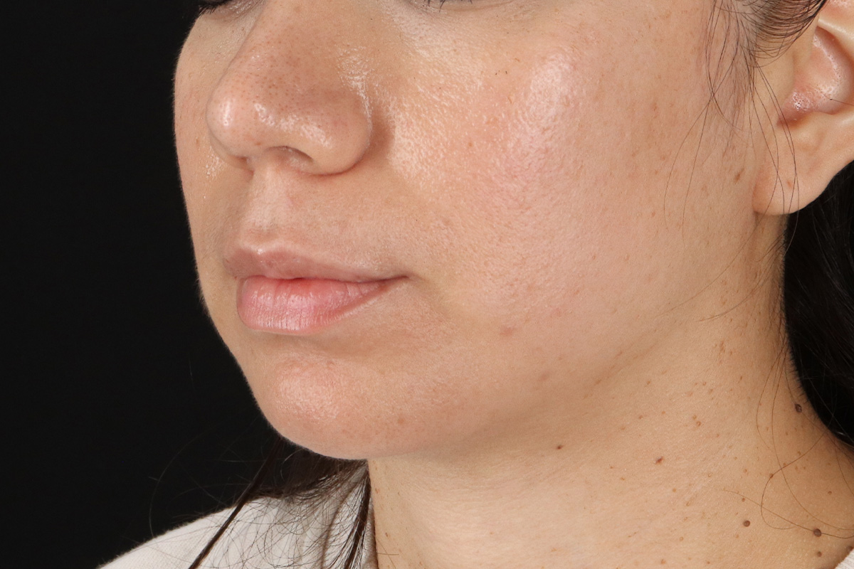 Chin Implant Before & After Patient #13783