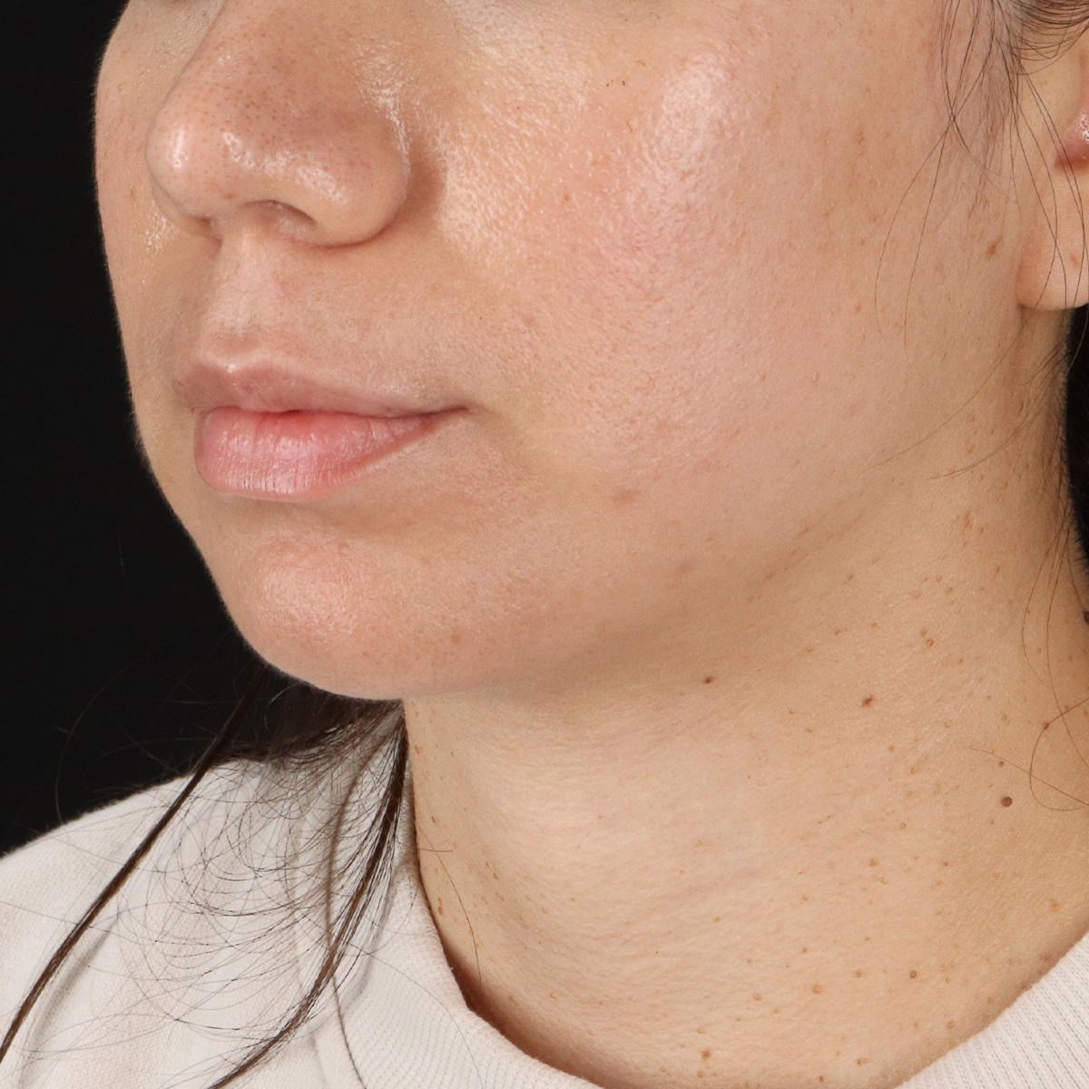 Neck Lift Before & After Patient #14047