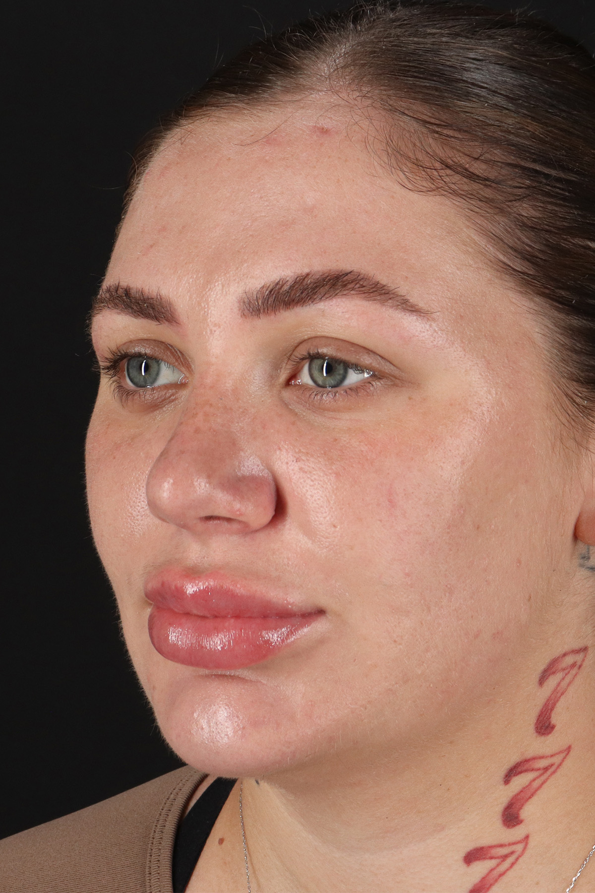Rhinoplasty Before & After Patient #12403