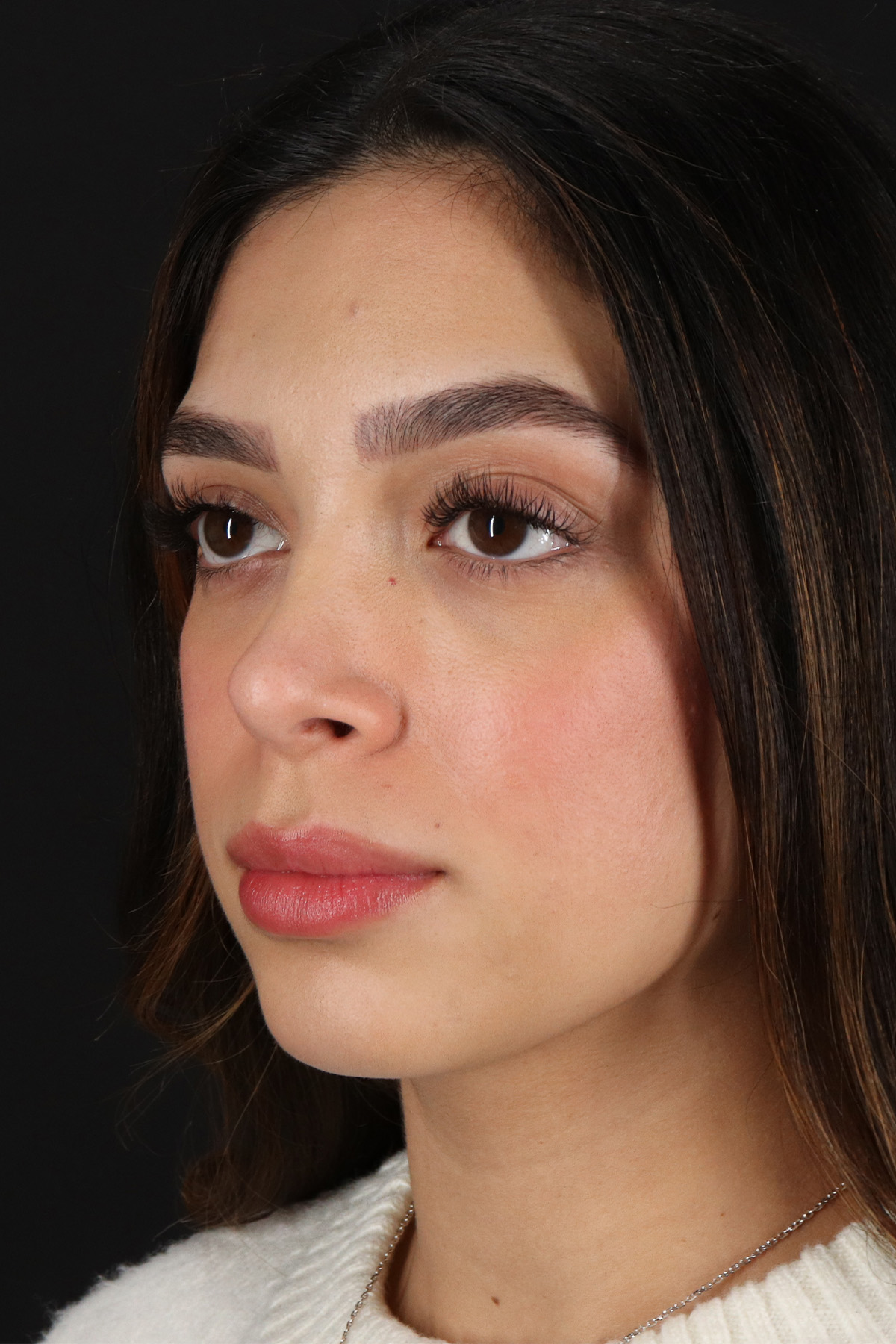 Rhinoplasty Before & After Patient #12249
