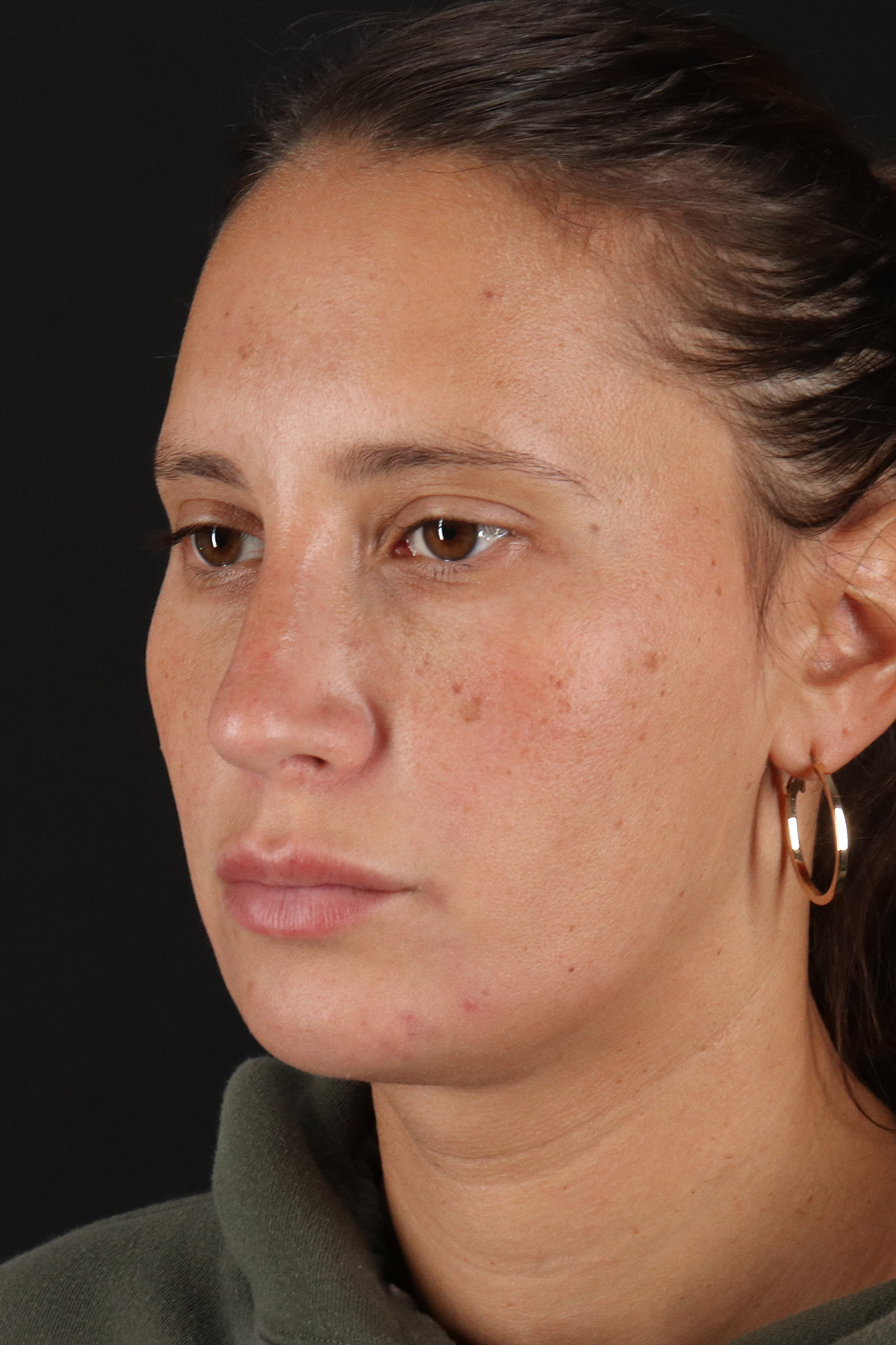 Chin Implant Before & After Patient #13728