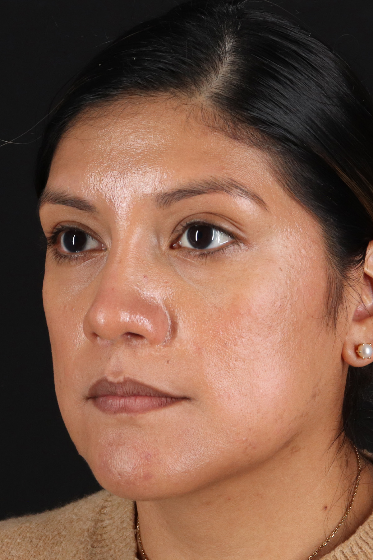 Rhinoplasty Before & After Patient #12337