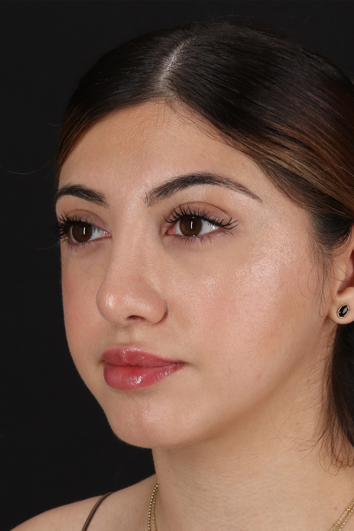 Rhinoplasty Before & After Patient #12304