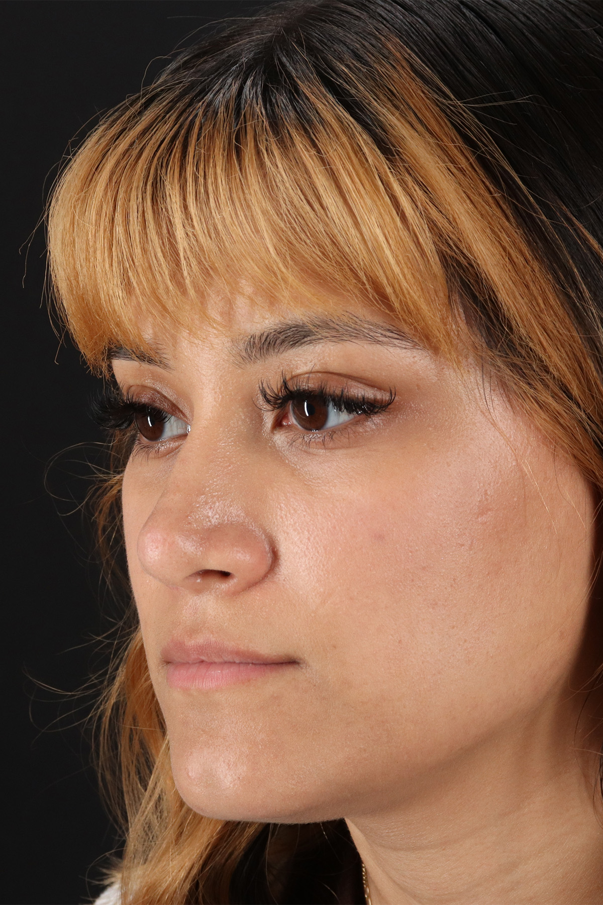 Rhinoplasty Before & After Patient #12469