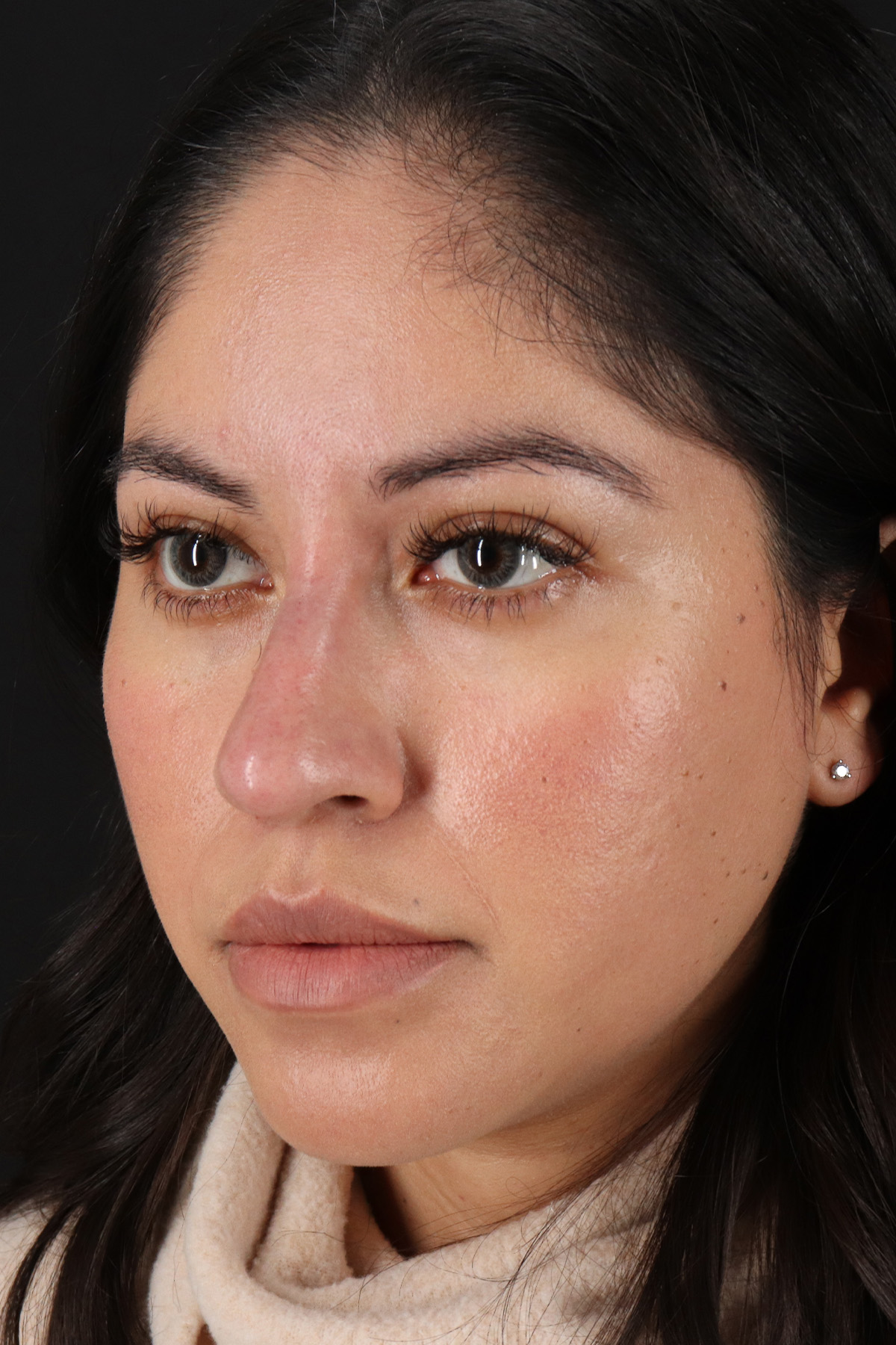 Fillers Before & After Patient #13276