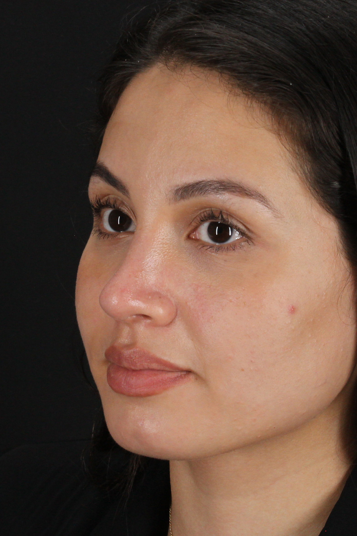 Rhinoplasty Before & After Patient #12282