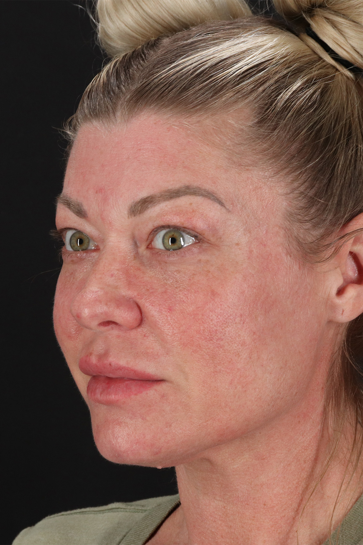 Lower Blepharoplasty Before & After Patient #13030