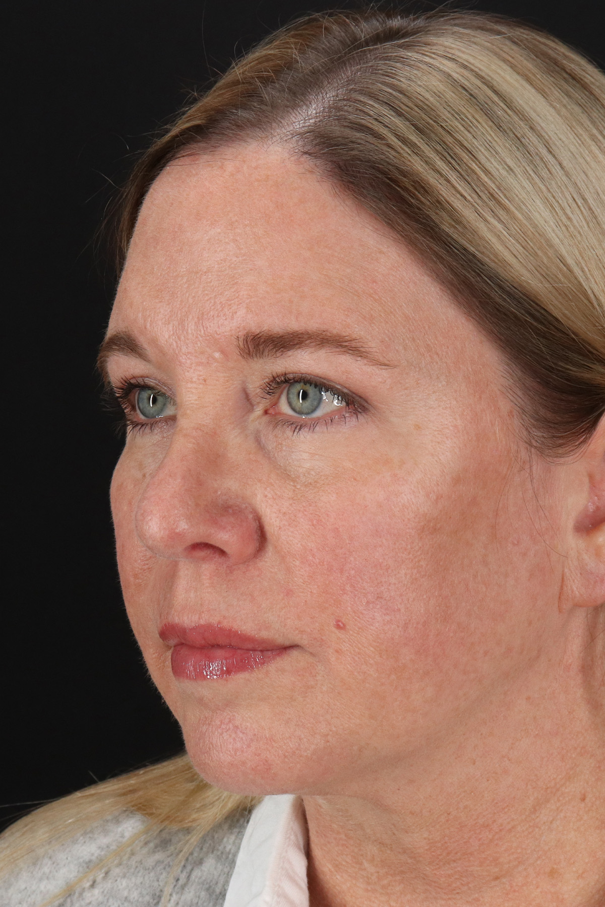 Upper Blepharoplasty Before & After Patient #12029