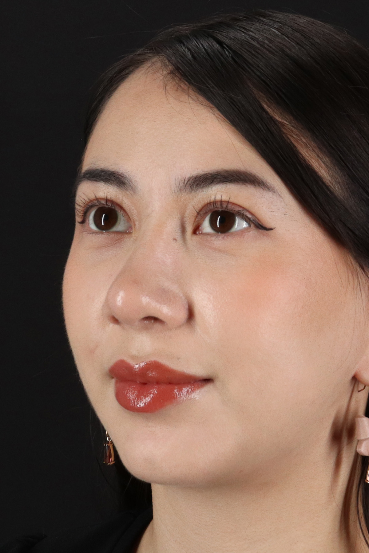 Rhinoplasty Before & After Patient #12359