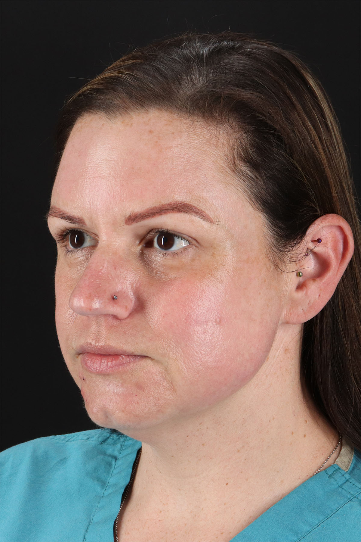 Chemical Peels Before & After Patient #11070