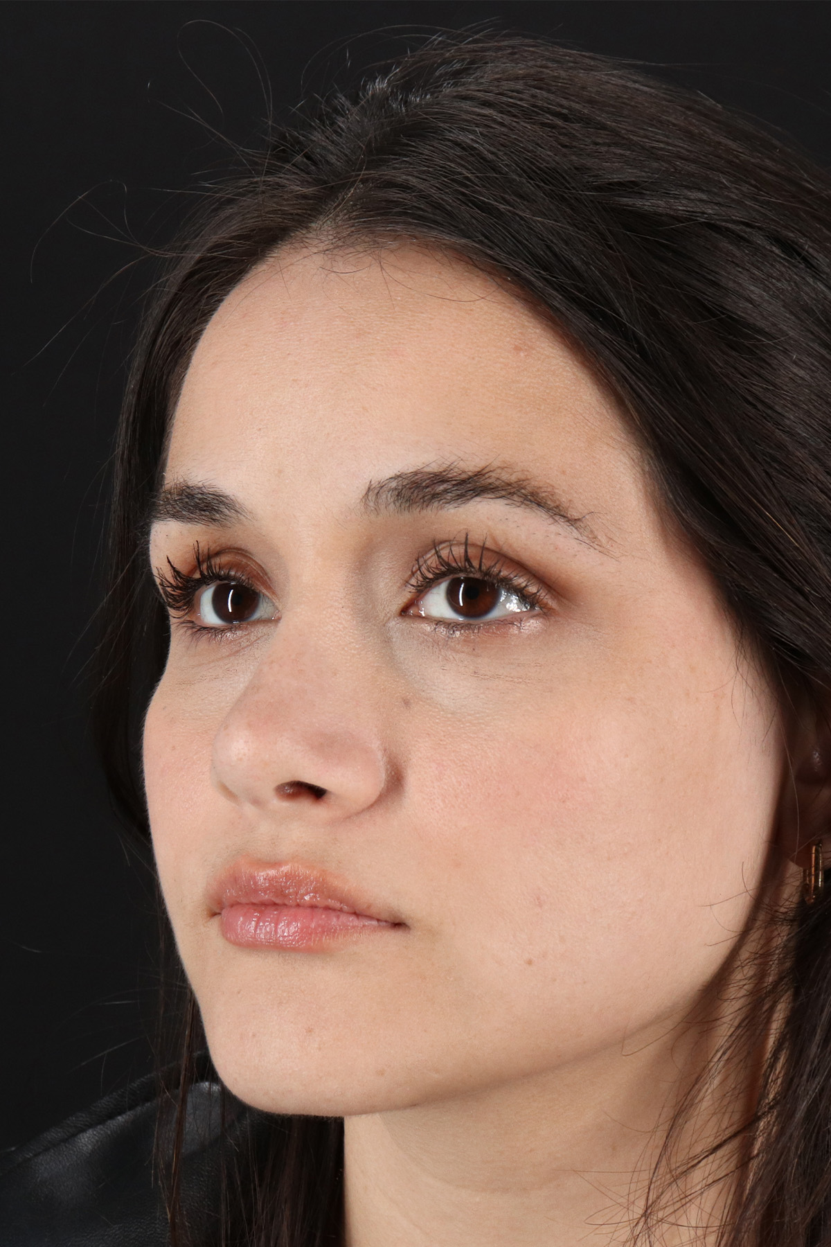 Rhinoplasty Before & After Patient #12260