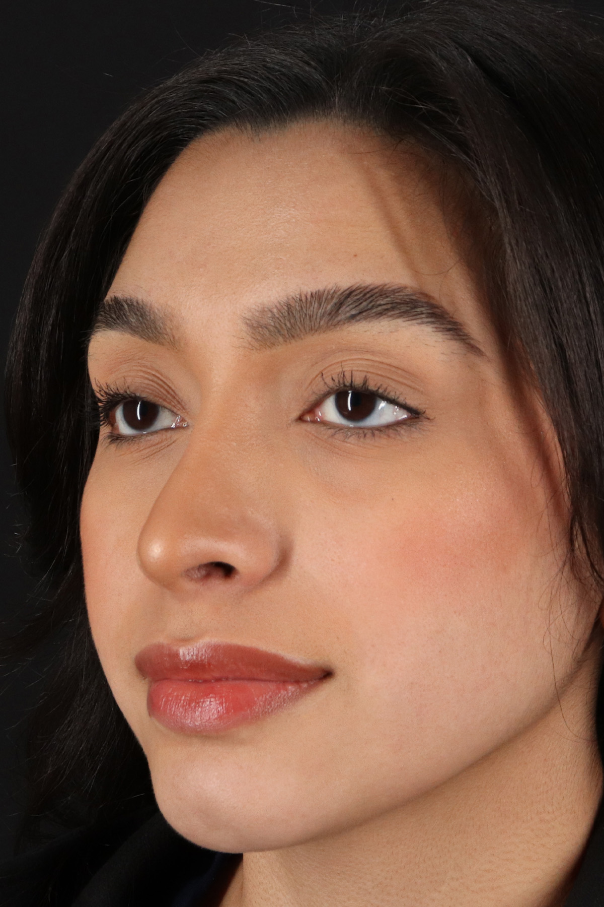 Chin Implant Before & After Patient #13706