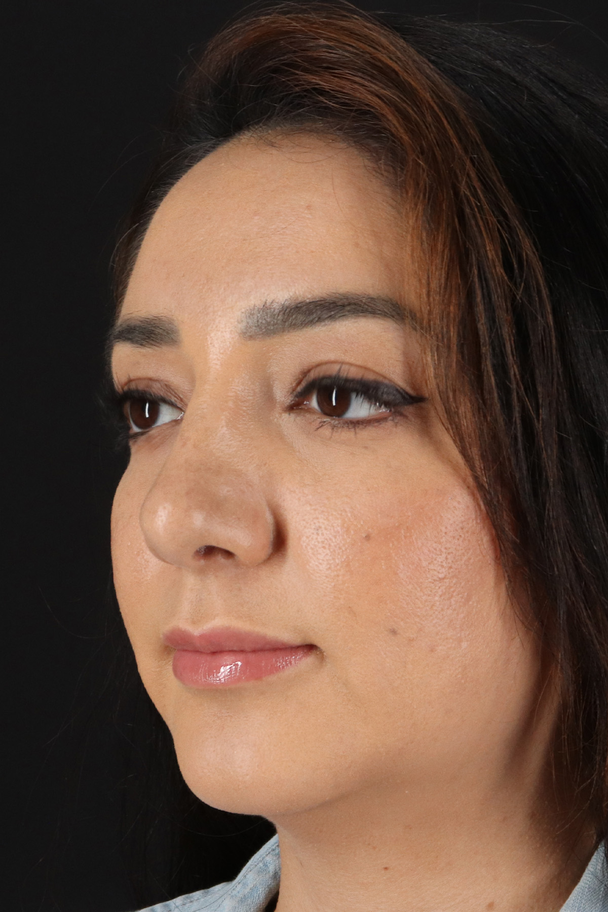 Rhinoplasty Before & After Patient #12392