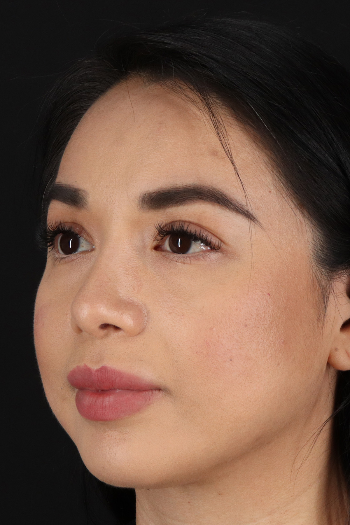 Chin Implant Before & After Patient #13717