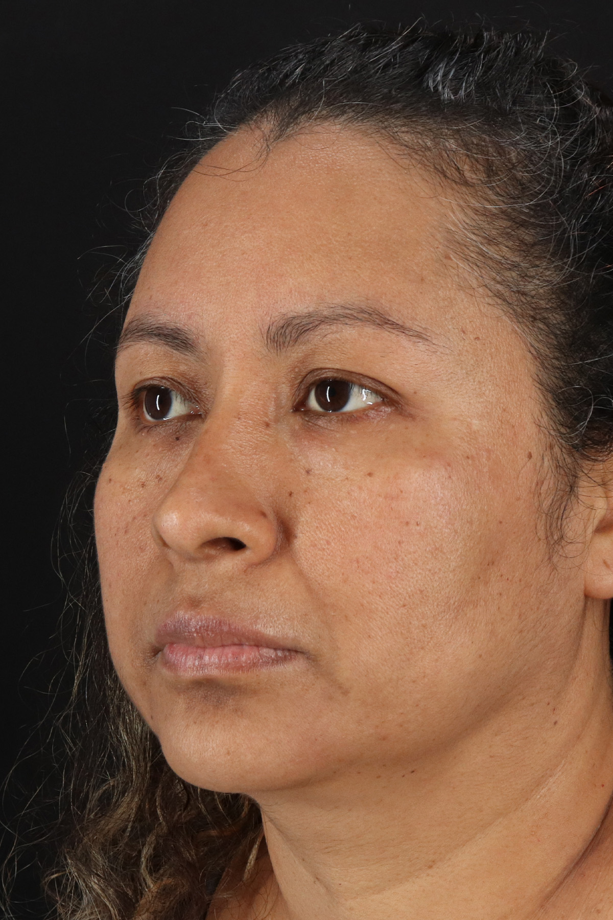 Rhinoplasty Before & After Patient #12293