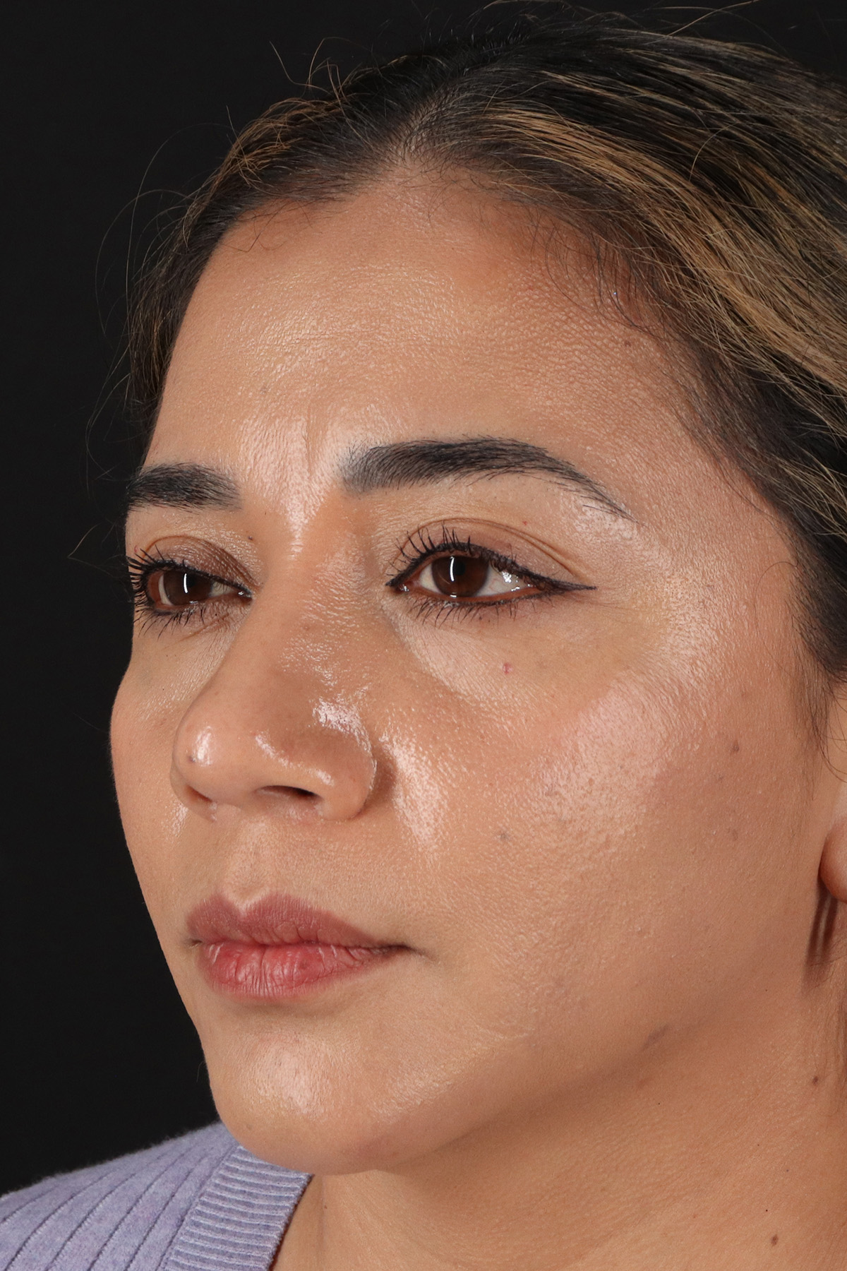 Rhinoplasty Before & After Patient #12425