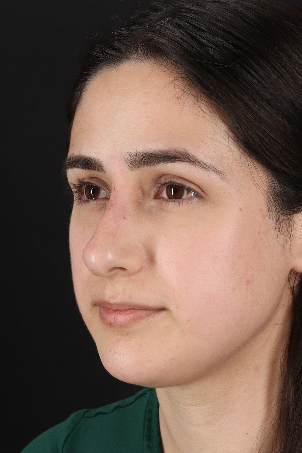 Liquid Rhinoplasty Before & After Patient #11339