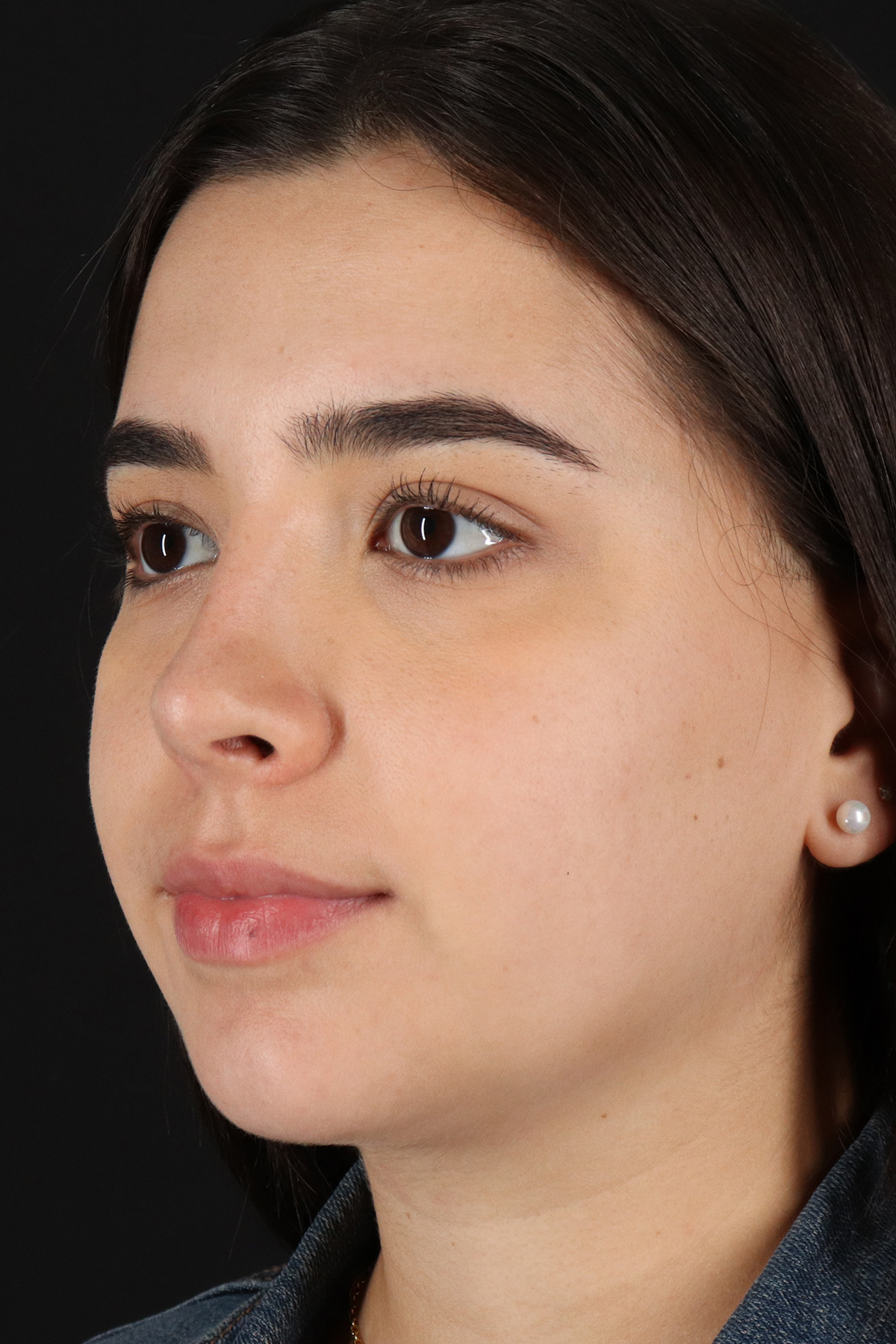 Chin Implant Before & After Patient #11694