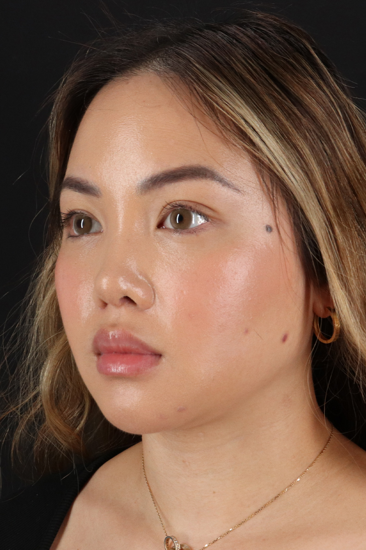 Chin Implant Before & After Patient #13816