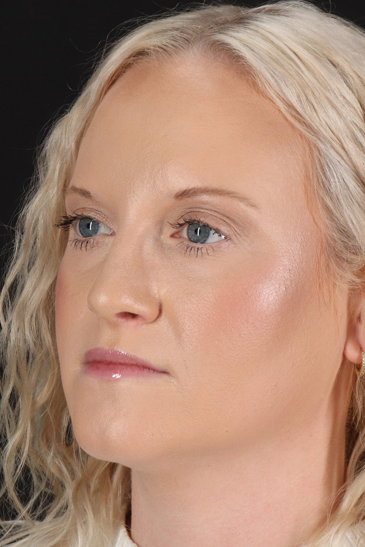 Rhinoplasty Before & After Patient #12381