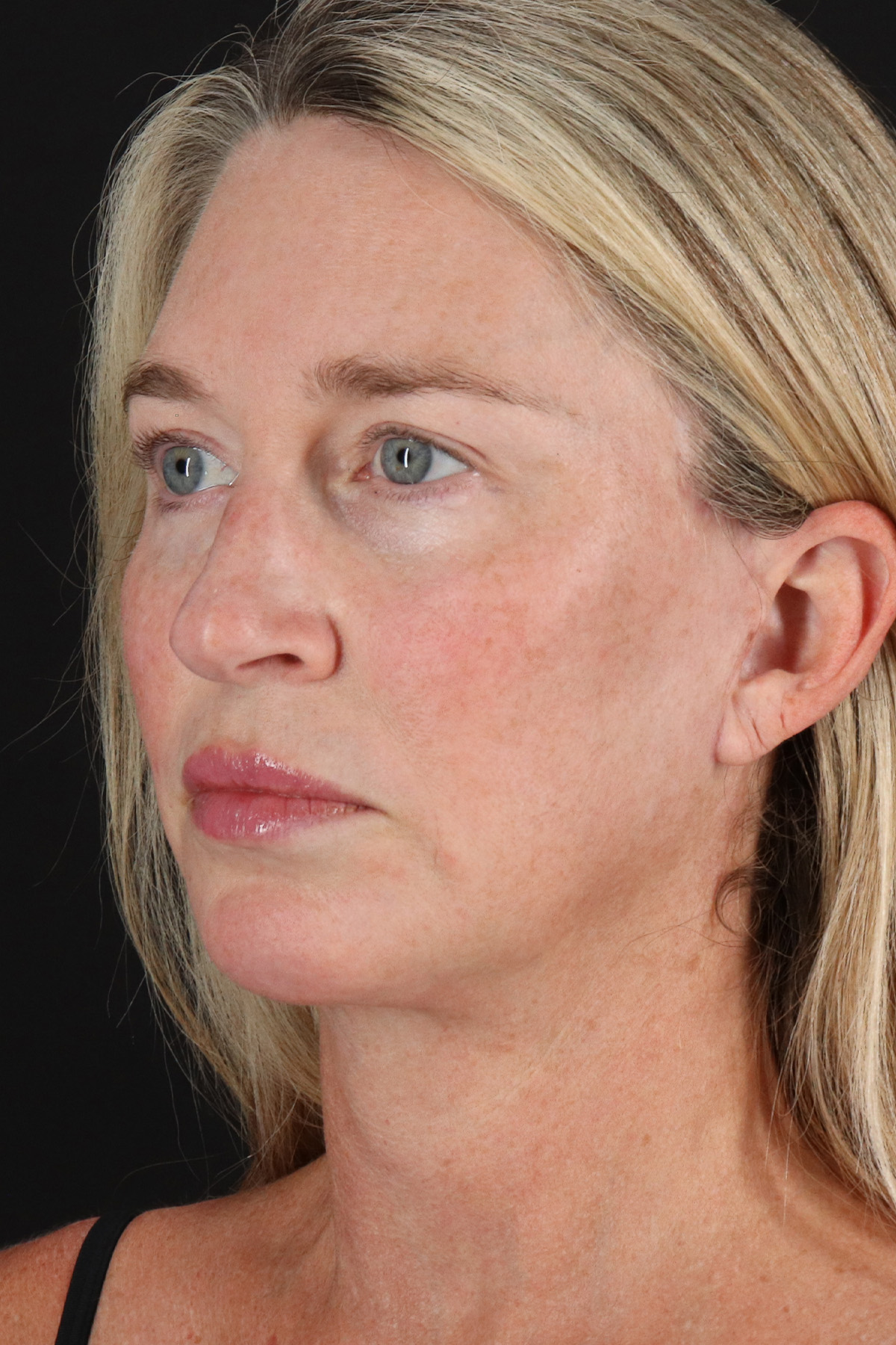 Upper Blepharoplasty Before & After Patient #12084
