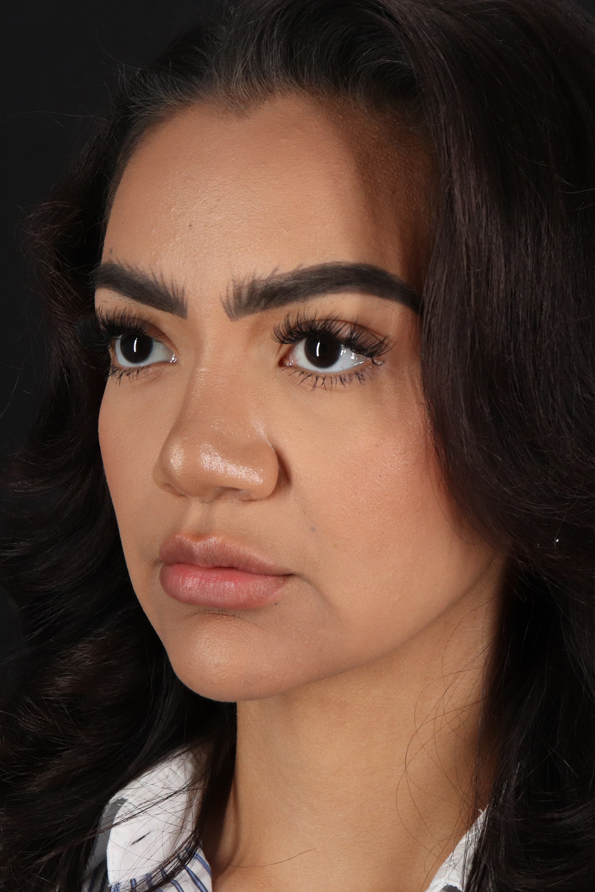 Rhinoplasty Before & After Patient #12326