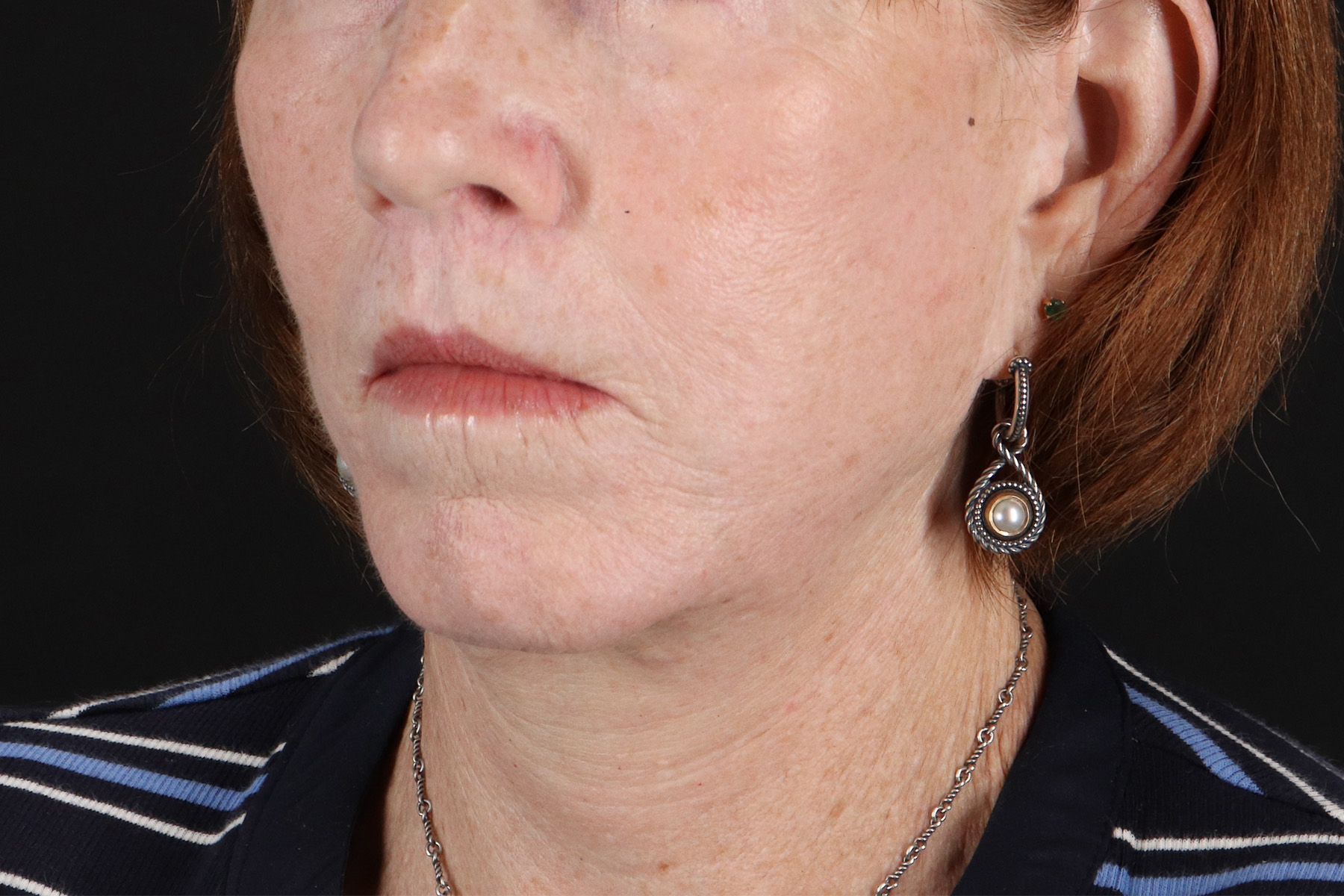 Neck Liposuction Before & After Patient #12117