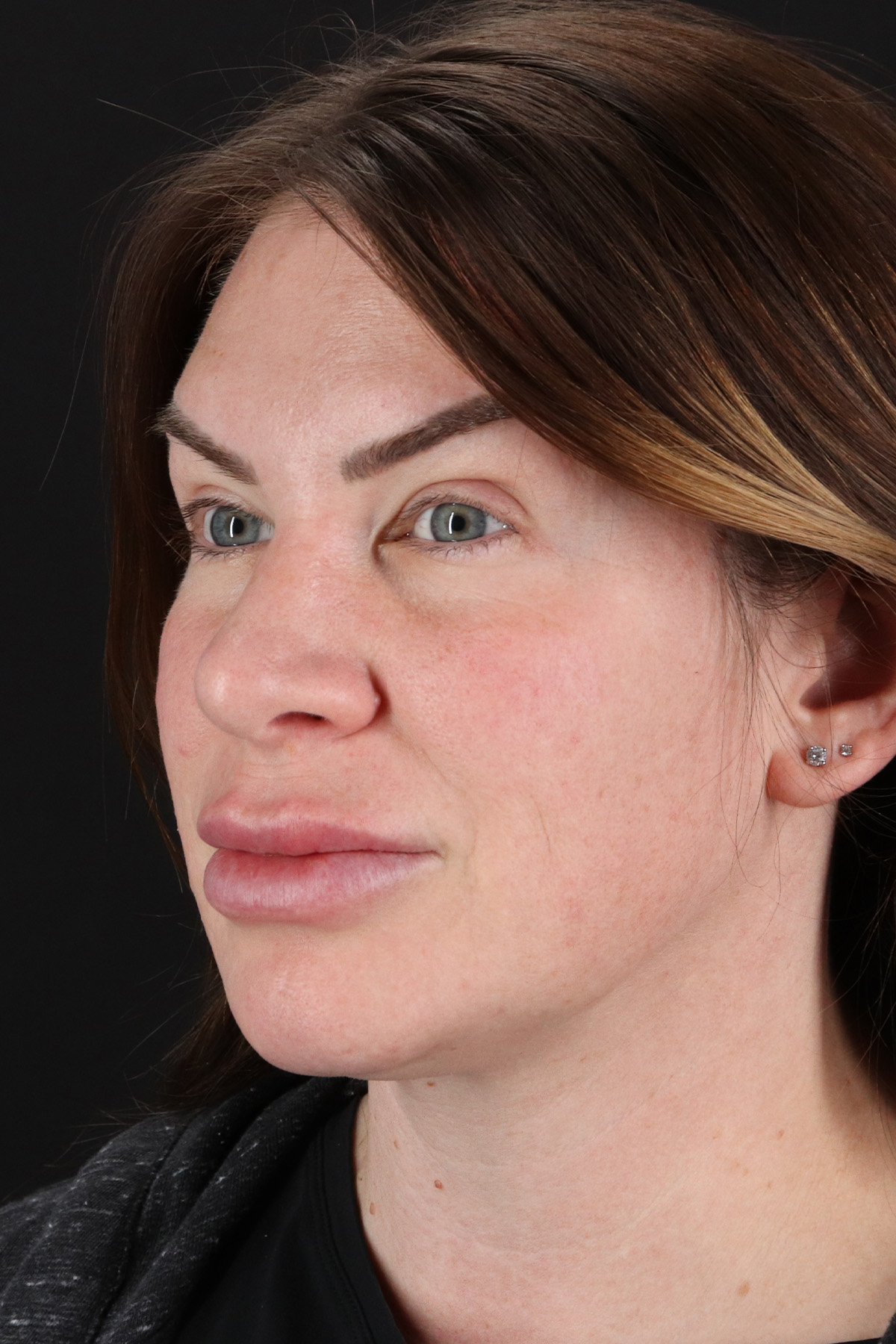 Rhinoplasty Before & After Patient #12414