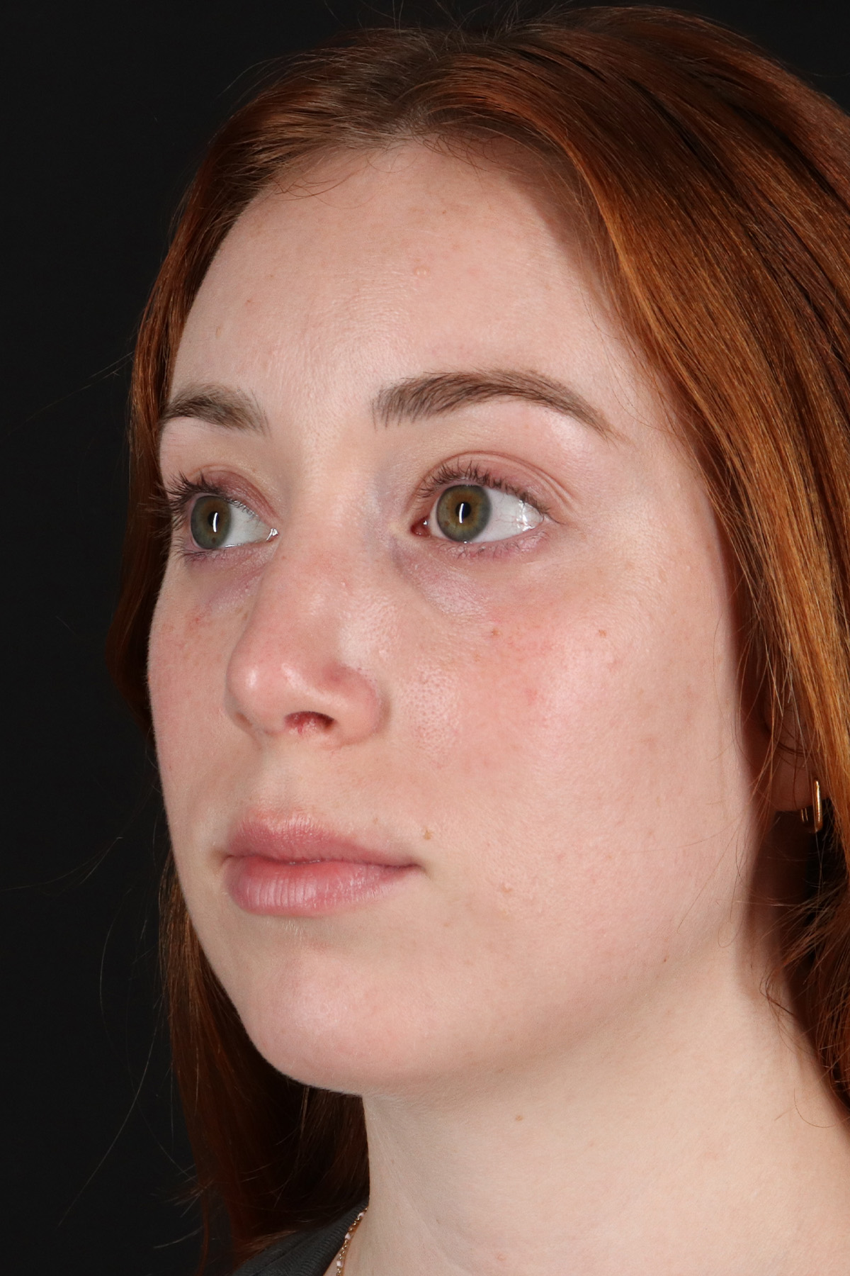 Rhinoplasty Before & After Patient #12348