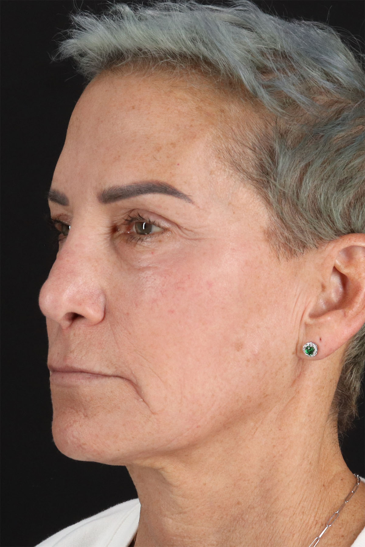 CO2 Laser Before & After Patient #10980
