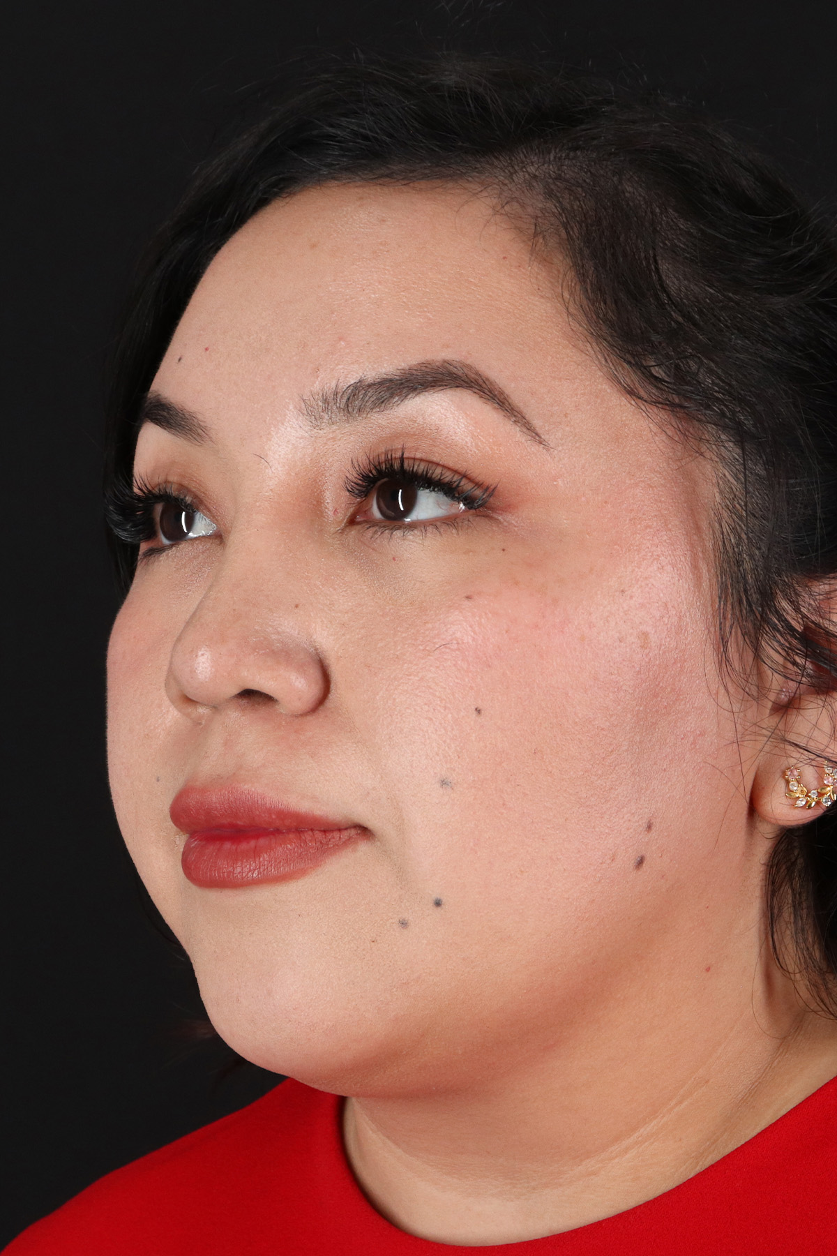 Rhinoplasty Before & After Patient #12447