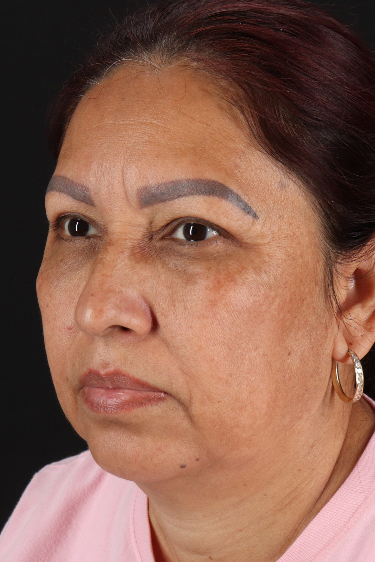Lower Blepharoplasty Before & After Patient #13085