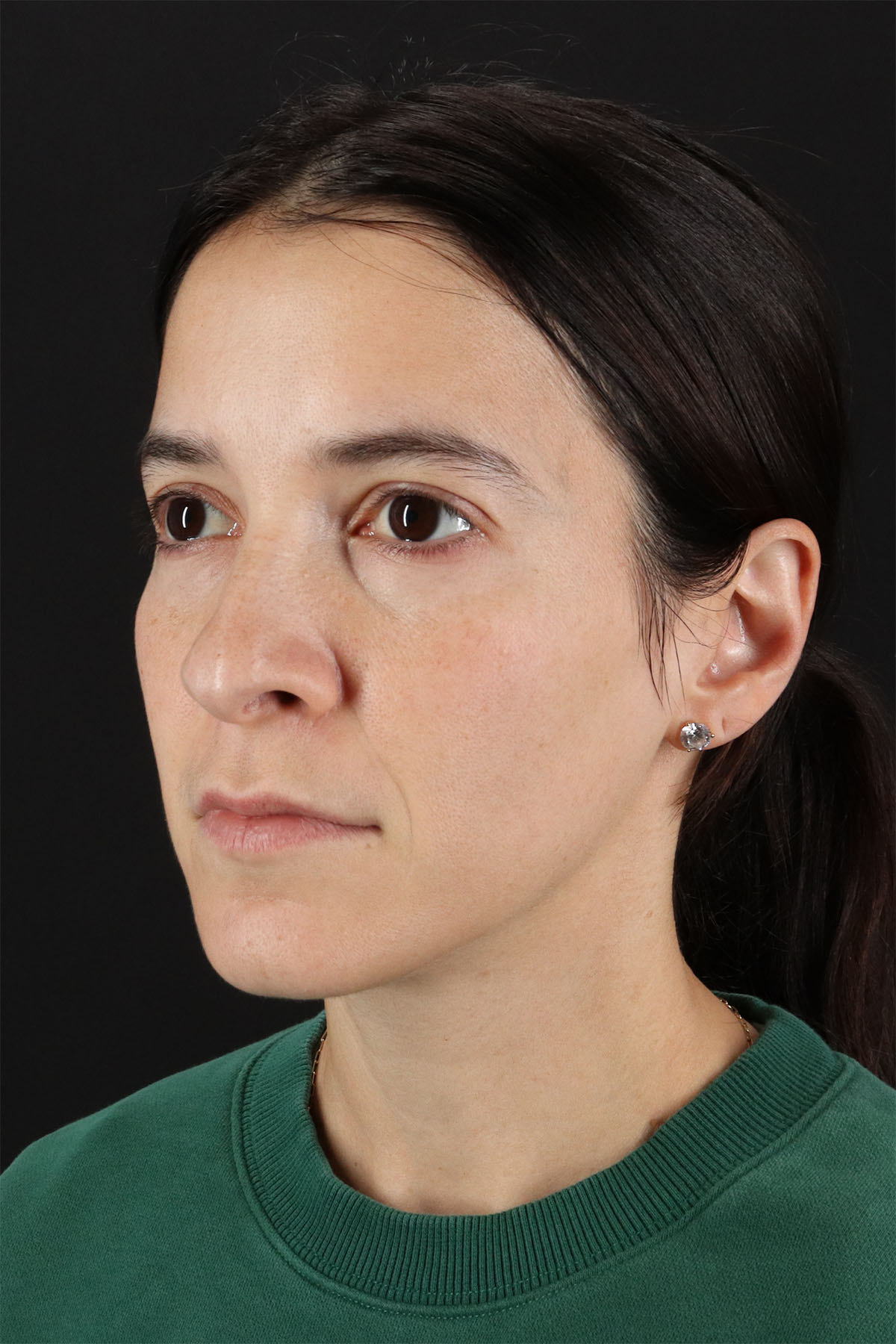 CO2 Laser Before & After Patient #11103