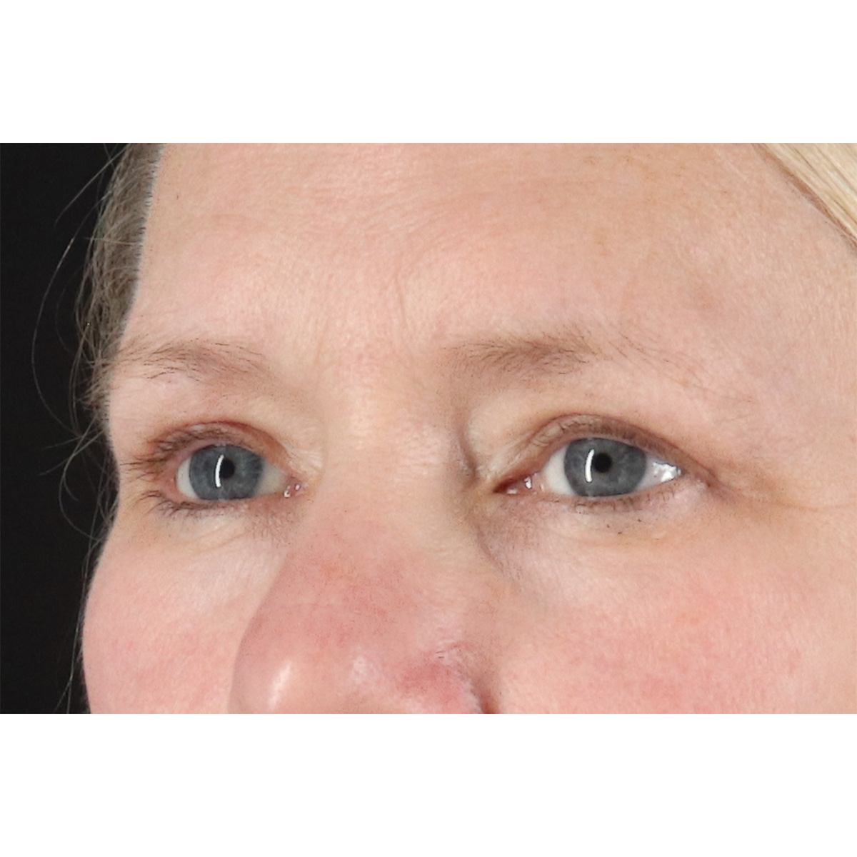 Blepharoplasty (Eyelid Surgery) Before & After Patient #10991