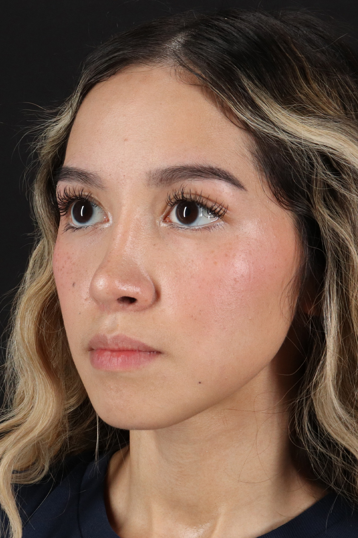 Rhinoplasty Before & After Patient #12216