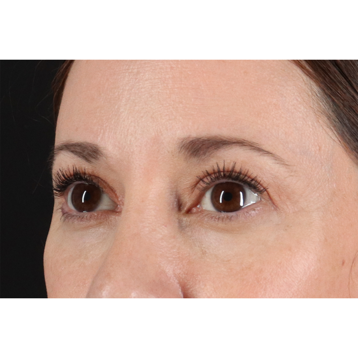 Blepharoplasty (Eyelid Surgery) Before & After Patient #11114