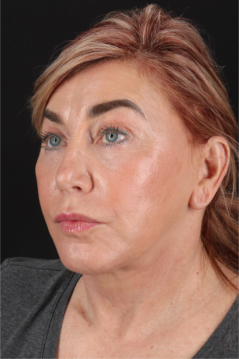 Fat Grafting To The Face Before & After Patient #11828
