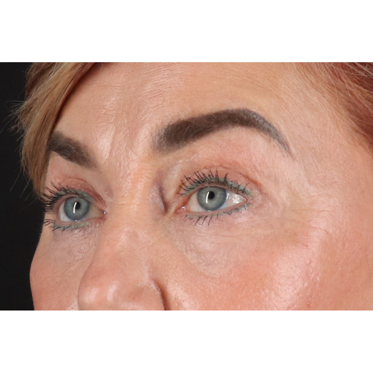 Blepharoplasty (Eyelid Surgery) Before & After Patient #11506