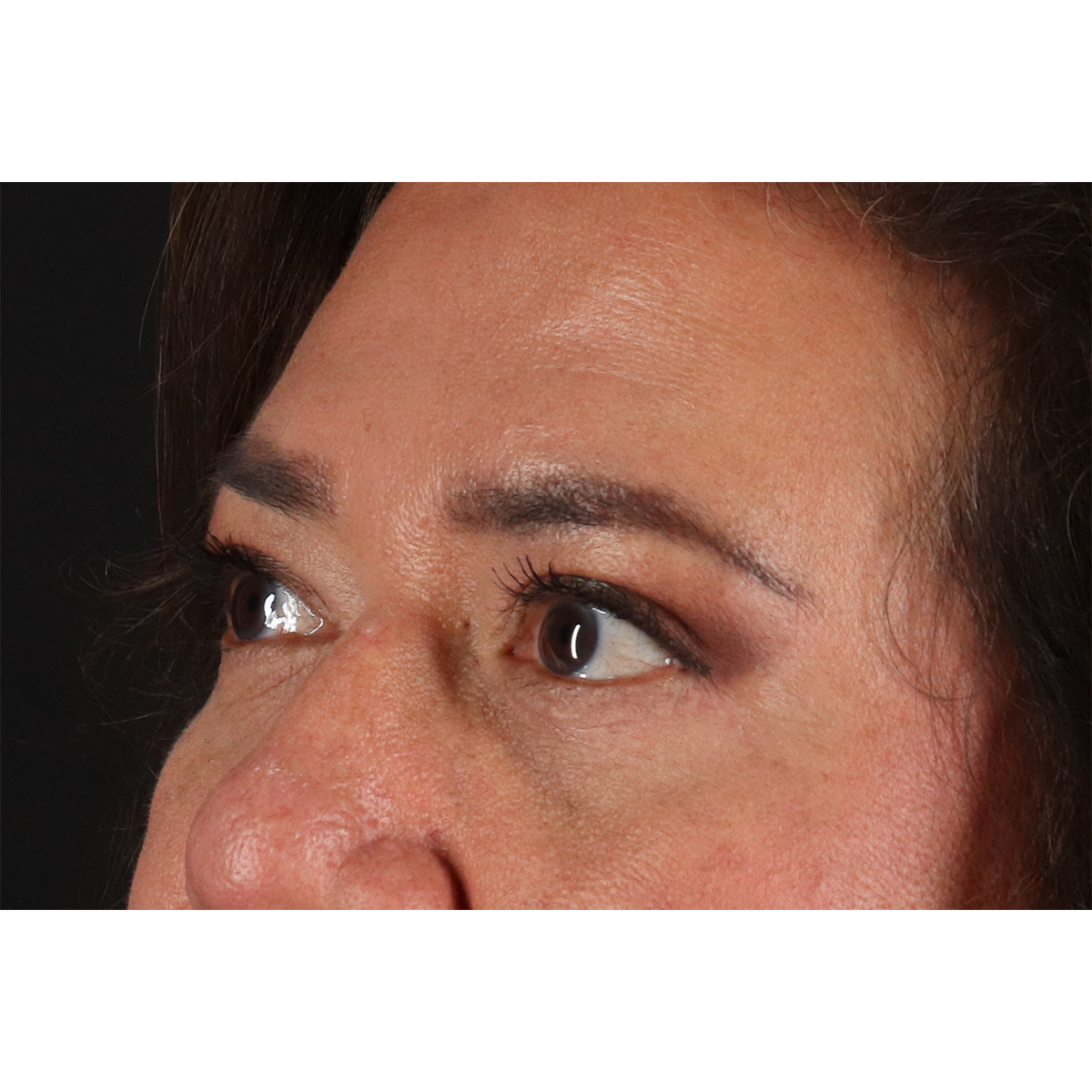 Blepharoplasty (Eyelid Surgery) Before & After Patient #11125