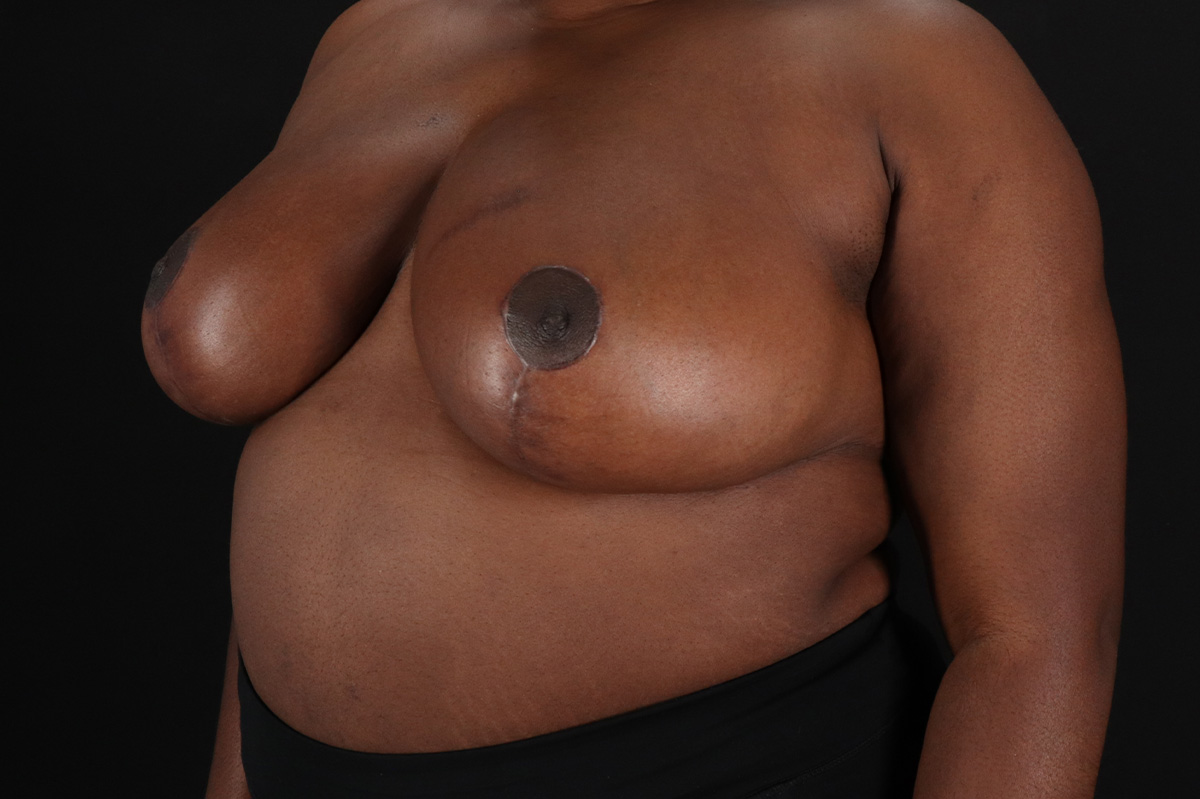 Breast Reduction With Lift Before & After Patient #11484