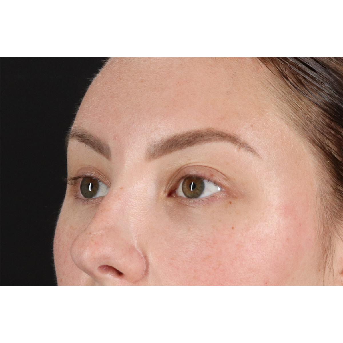 Brow Lift Before & After Patient #11657