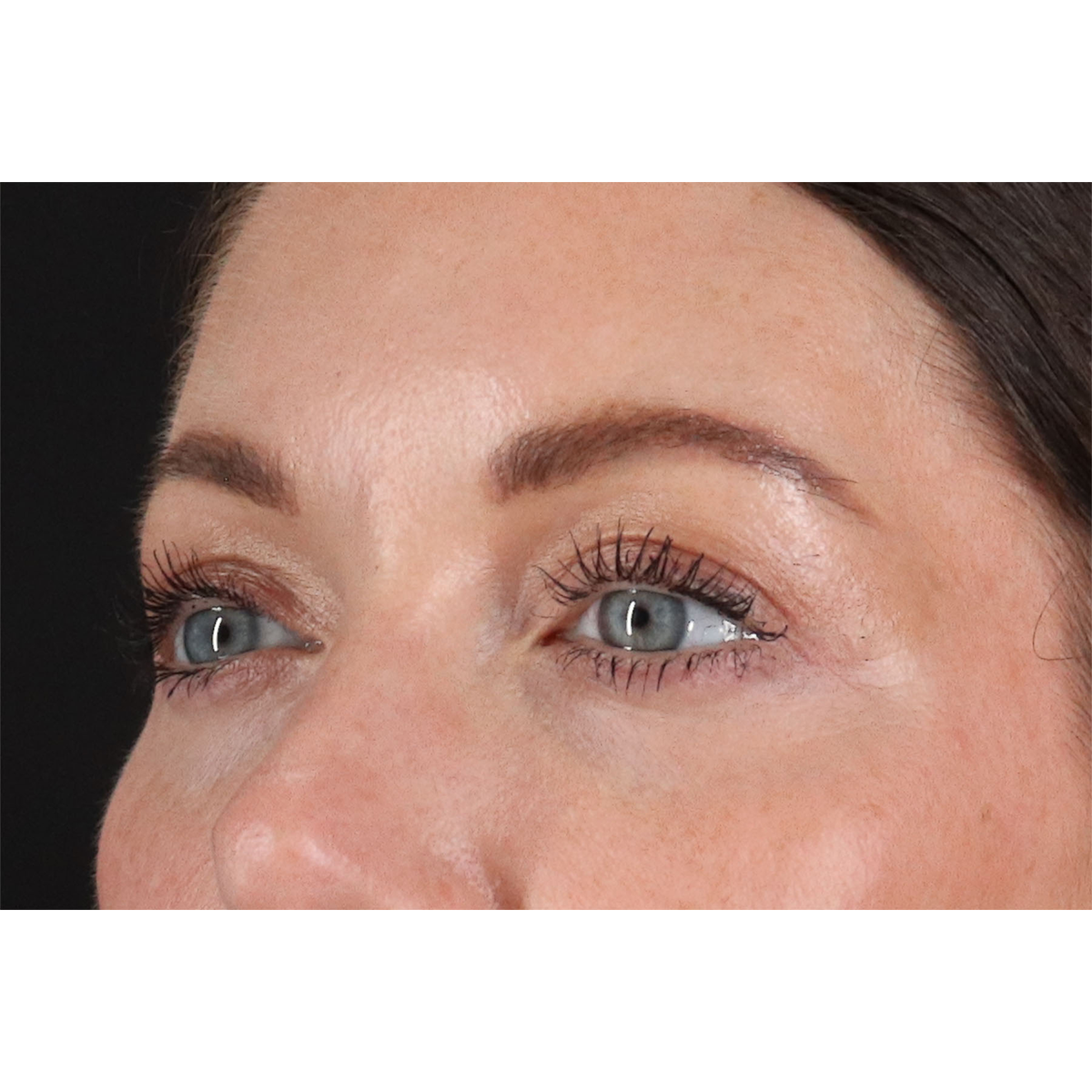 Blepharoplasty (Eyelid Surgery) Before & After Patient #11026