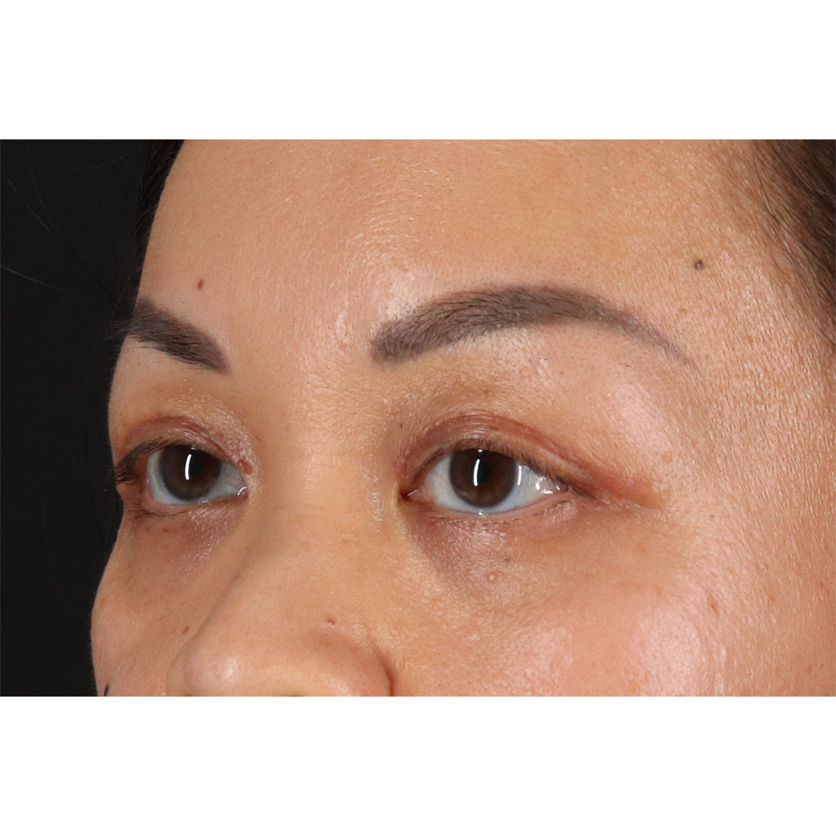 Blepharoplasty (Eyelid Surgery) Before & After Patient #11037
