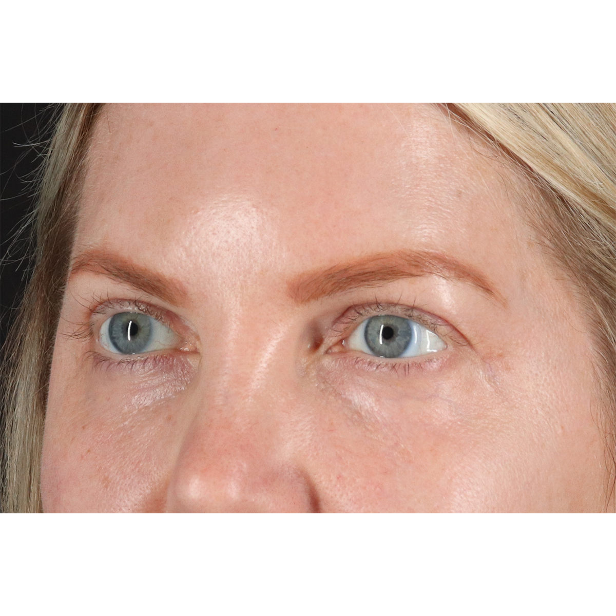 Blepharoplasty (Eyelid Surgery) Before & After Patient #11158