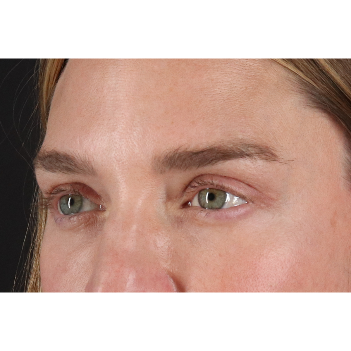Blepharoplasty (Eyelid Surgery) Before & After Patient #11541