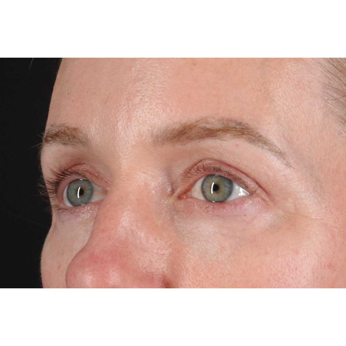 Blepharoplasty (Eyelid Surgery) Before & After Patient #11883