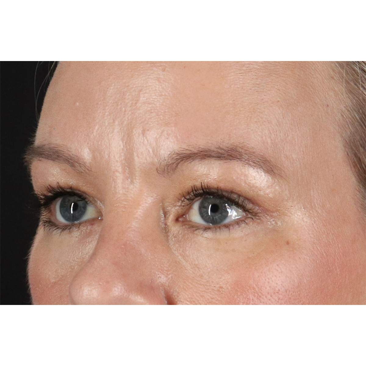 Blepharoplasty (Eyelid Surgery) Before & After Patient #11048
